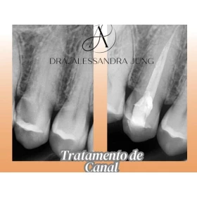 Foto Tratamento Endodôntico (Canal)