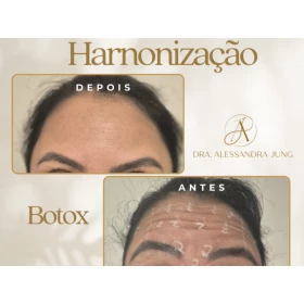 Foto Harmonização Orofacial