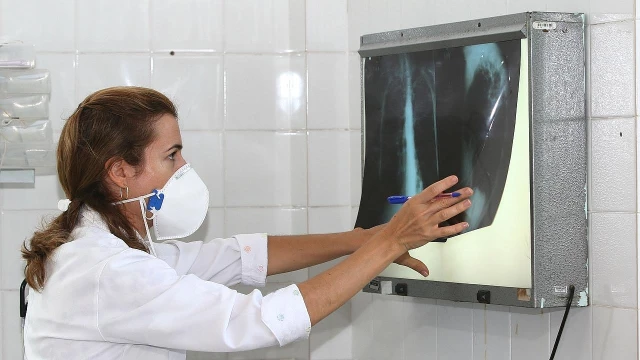 Campanha para diagnóstico de tuberculose é intensificada em Taubaté