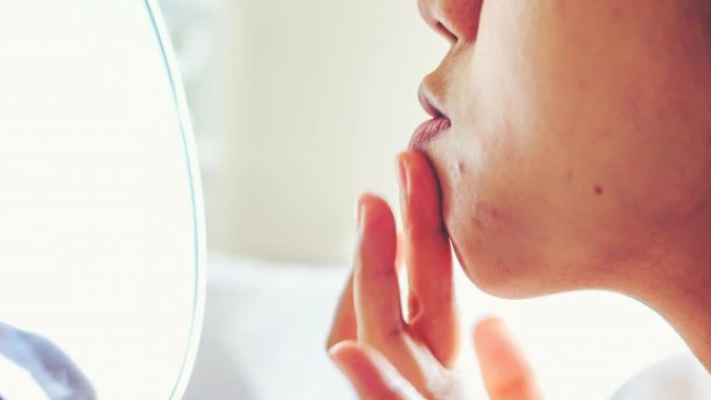 Sociedade médica alerta para uso indevido do remédios para acnes