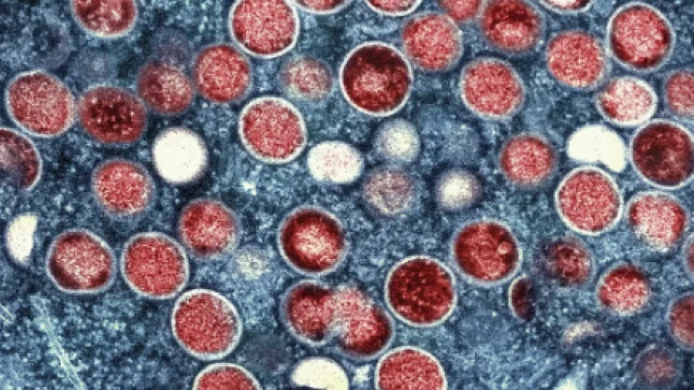 Entenda o que é a doença Mpox 