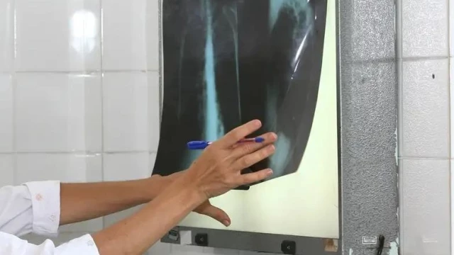 Taubaté intensifica busca ativa de casos de tuberculose