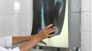 Taubaté: Taubaté intensifica busca ativa de casos de tuberculose