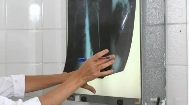 Taubaté intensifica busca ativa de casos de tuberculose