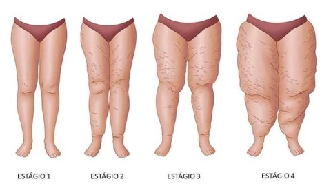 Lipedema ou só uma Celulite?