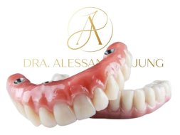 Implantes Dentários