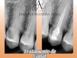 Tratamento Endodôntico (Canal)