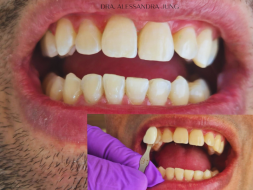 Clareamento Dental